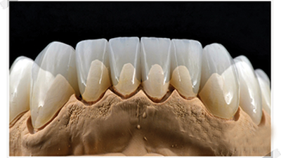 Crown Zirconia Melbourne