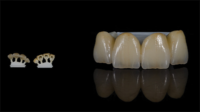 Crown Implant Services Melbourne